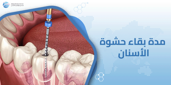 مدة بقاء حشوة الأسنان