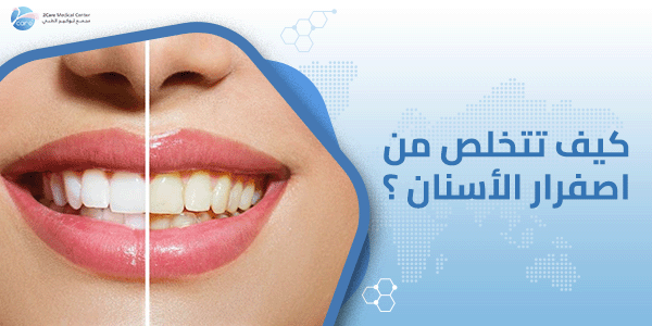 كيف تتخلص من اصفرار الأسنان