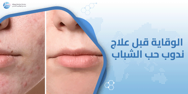 الوقاية قبل علاج ندوب حب الشباب