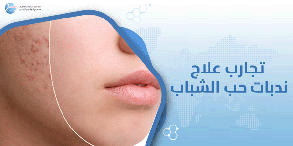 تجارب علاج ندبات حب الشباب